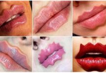 Lábios do Diabo: Cirurgião plástico faz alerta para nova tendência estética, que pode deformar a boca