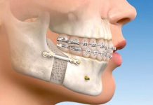 Cirurgia Ortognática, cada vez mais procurada pelos portadores de problemas de mordida e de face