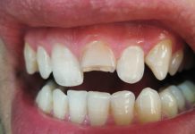 Trauma dental: dentista ensina o que fazer com dente quebrado