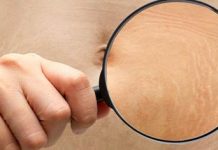 Hidratação da pele ajuda a prevenir e melhorar estrias? Dr. Marco Cassol responde