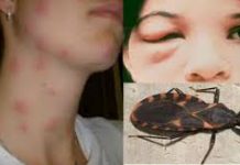Primeiro Dia Mundial da Doença de Chagas, será celebrado nesta terça-feira(14 de abril)
