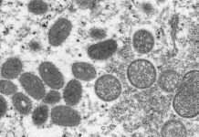 Jaboatão inicia coleta domiciliar para diagnóstico do vírus Monkeypox, também conhecida como Varíola dos Macacos