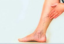 Tratamento de varizes: Veja a importância da fisioterapia