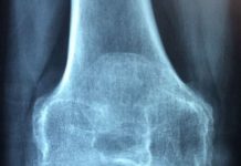 Osteoporose pode ser prevenida com medidas simples