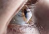 Dia Mundial do Ceratocone: médica alerta que coçar os olhos é a principal causa da doença