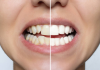 Sorriso desalinhado? Vejas 6 problemas que vão além da saúde bucal