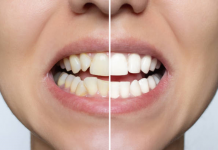 Sorriso desalinhado? Vejas 6 problemas que vão além da saúde bucal