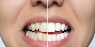Sorriso desalinhado? Vejas 6 problemas que vão além da saúde bucal