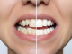 Sorriso desalinhado? Vejas 6 problemas que vão além da saúde bucal
