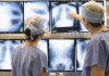 Novo protocolo de tratamento do câncer de pulmão propõe ampliar o acesso à cirurgia torácica assistida por vídeo, para pacientes do SUS